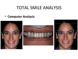 TOTAL SMILE ANALYSIS
• Computer Analysis
 