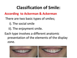 Classification of Smile:
According to Ackerman & Ackerman
There are two basic types of smiles;
i). The social smile
ii). The enjoyment smile.
Each type involves a different anatomic
presentation of the elements of the display
zone.
 