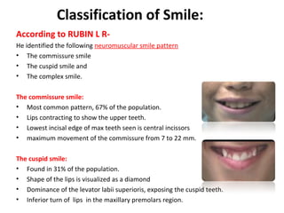 Classification of Smile:
According to RUBIN L R-
He identified the following neuromuscular smile pattern
• The commissure smile
• The cuspid smile and
• The complex smile.
The commissure smile:
• Most common pattern, 67% of the population.
• Lips contracting to show the upper teeth.
• Lowest incisal edge of max teeth seen is central incissors
• maximum movement of the commissure from 7 to 22 mm.
The cuspid smile:
• Found in 31% of the population.
• Shape of the lips is visualized as a diamond
• Dominance of the levator labii superioris, exposing the cuspid teeth.
• Inferior turn of lips in the maxillary premolars region.
 