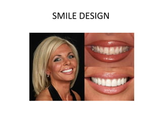 SMILE DESIGN
 