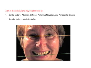 A tilt in the incisal plane may be attributed to;
• Dental factors - Attrition, Different Patterns of Eruption, and Periodontal Disease
• Skeletal factors - slanted maxilla.
 