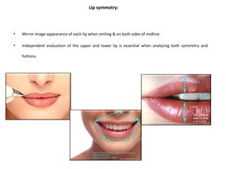 Lip symmetry:
• Mirror image appearance of each lip when smiling & on both sides of midline.
• Independent evaluation of the upper and lower lip is essential when analyzing both symmetry and
fullness.
 