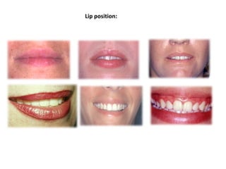Lip position:
 