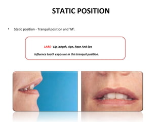STATIC POSITION
• Static position - Tranquil position and ‘M’.
LARS - Lip Length, Age, Race And Sex
Influence tooth exposure in this tranquil position.
 