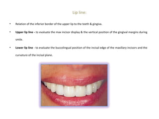 Lip line:
• Relation of the inferior border of the upper lip to the teeth & gingiva.
• Upper lip line - to evaluate the max incisor display & the vertical position of the gingival margins during
smile.
• Lower lip line - to evaluate the buccolingual position of the incisal edge of the maxillary incisors and the
curvature of the incisal plane.
 