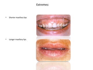 Extremes:
• Shorter maxillary lips
• Longer maxillary lips
 