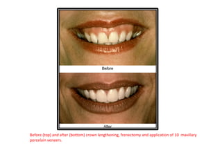 Before (top) and after (bottom) crown lengthening, frenectomy and application of 10 maxillary
porcelain veneers.
 