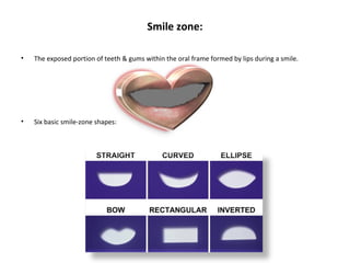 Smile zone:
• The exposed portion of teeth & gums within the oral frame formed by lips during a smile.
• Six basic smile-zone shapes:
 