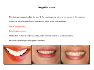Negative space:
• The dark space appearing b/w the jaws & the mouth opening either at the corner of the mouth or
around the buccal aspect of the posterior teeth during active smile and laugh.
• Lateral negative space
• Buccal negative spaces.
• Obliteration of these essential spaces by dental elements lead to an unattractive smile.
• Excessive negative space also appear unesthetic.
 