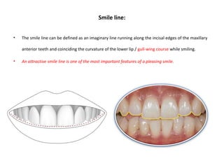 Smile line:
• The smile line can be defined as an imaginary line running along the incisal edges of the maxillary
anterior teeth and coinciding the curvature of the lower lip / gull-wing course while smiling.
• An attractive smile line is one of the most important features of a pleasing smile.
 