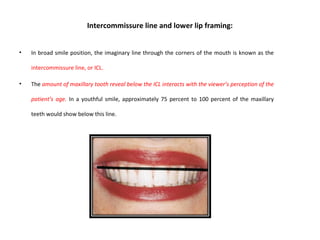 Intercommissure line and lower lip framing:
• In broad smile position, the imaginary line through the corners of the mouth is known as the
intercommissure line, or ICL.
• The amount of maxillary tooth reveal below the ICL interacts with the viewer’s perception of the
patient’s age. In a youthful smile, approximately 75 percent to 100 percent of the maxillary
teeth would show below this line.
 
