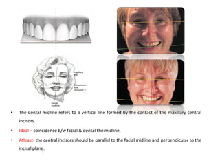 • The dental midline refers to a vertical line formed by the contact of the maxillary central
incisors.
• Ideal – coincidence b/w facial & dental the midline.
• Atleast- the central incisors should be parallel to the facial midline and perpendicular to the
incisal plane.
 