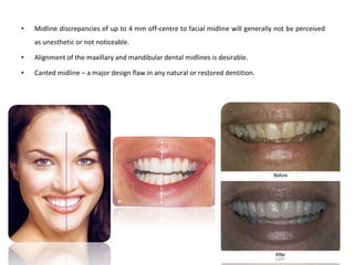 • Midline discrepancies of up to 4 mm off-centre to facial midline will generally not be perceived
as unesthetic or not noticeable.
• Alignment of the maxillary and mandibular dental midlines is desirable.
• Canted midline – a major design flaw in any natural or restored dentition.
 