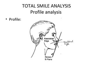 TOTAL SMILE ANALYSIS
Profile analysis
• Profile:
 
