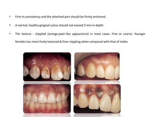 • Firm in consistency and the attached part should be firmly anchored.
• A normal, healthy gingival sulcus should not exceed 3 mm in depth.
• The texture - stippled (orange-peel–like appearance) in most cases. Fine or coarse. Younger
females has more finely textured & finer stippling when compared with that of males.
 