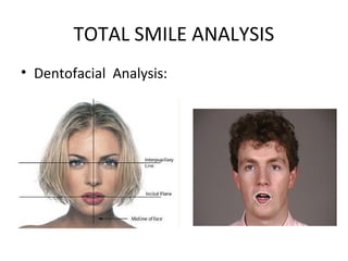 TOTAL SMILE ANALYSIS
• Dentofacial Analysis:
 