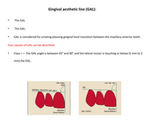 Gingival aesthetic line (GAL):
• The GAL
• The GAL.
• GAL is considered for creating pleasing gingival level transition between the maxillary anterior teeth.
Four classes of GAL can be described:
• Class I — The GAL angle is between 45° and 90° and the lateral incisor is touching or below (1 mm to 2
mm) the GAL .
 