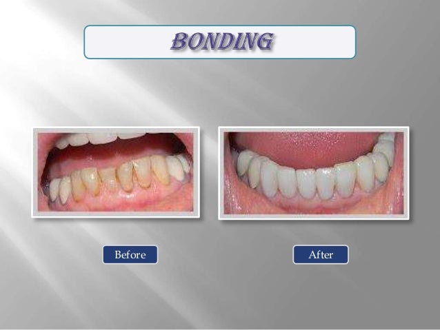 Smile gallery Cosmetic Dentistry Options at Pearl Dental