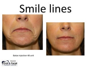 Smile lines
Botox injection 40 unit
 