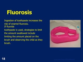 18 www.aap.org/oralhealth/pact
Fluorosis
Ingestion of toothpaste increases the
risk of enamel fluorosis.
If fluoride
toothpaste is used, strategies to limit
the amount swallowed include
limiting the amount placed on the
brush and observing the child as they
brush.
Used with permission from Rama Oskouian
 