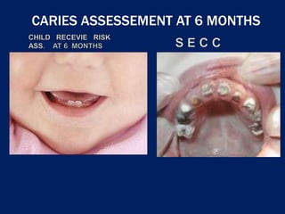 CARIES ASSESSEMENT AT 6 MONTHS
 
