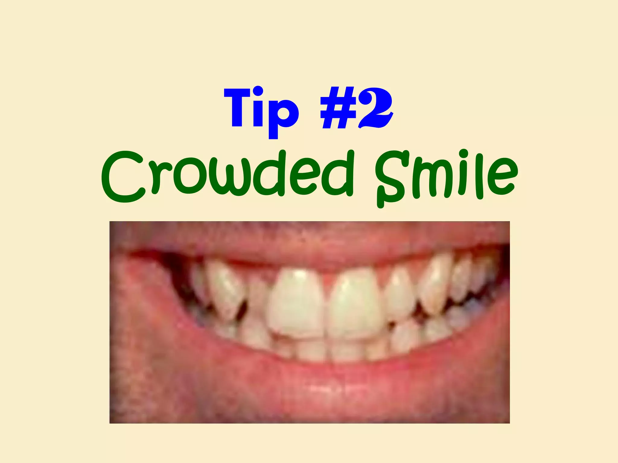 Tip #2
Crowded Smile

 