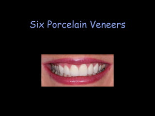 Two Porcelain Veneers Dentistry by Dr. Ryan Sellinger www.DrSellinger.com 212.267.1884 Here two Veneers were used to address our patients requests.  She didn’t like the bulkiness and protrusion of her teeth along with the slight spaces caused by the over tapered shape of her teeth.  The teeth were contoured back into the smile and all of her requests were accomplished with conservative treatment treating only two teeth to compliment her smile. 