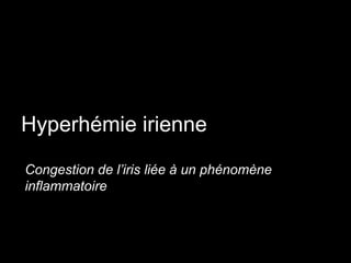 Hyperhémie irienne
Congestion de l’iris liée à un phénomène
inflammatoire

 