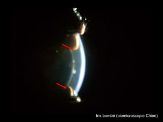 Iris bombé (biomicroscopie Chien)

 