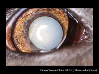 Hétérochromie inflammatoire (cataracte diabétique)

 