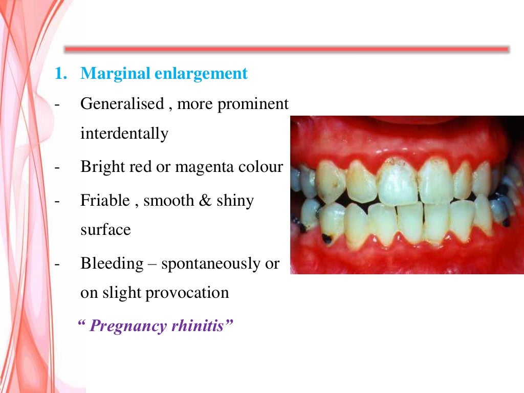 Gingival enlargement