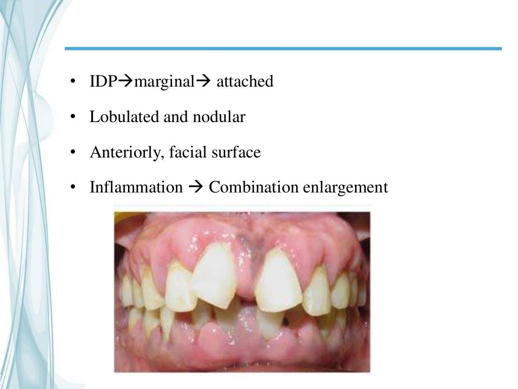 Gingival enlargement