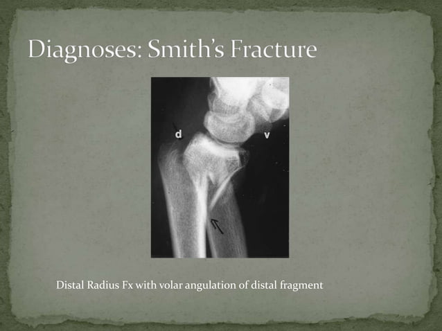 Smith’s fracture | PPTX
