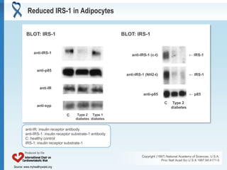 Source: www.myhealthywaist.orgSource: www.myhealthywaist.org
Reduced IRS-1 in Adipocytes
Copyright (1997) National Academy of Sciences, U.S.A.
Proc Natl Acad Sci U S A 1997;94:4171-5
anti-IRS-1
anti-p85
anti-IR
anti-syp
C Type 2
diabetes
Type 1
diabetes
BLOT: IRS-1 BLOT: IRS-1
anti-IRS-1 (c-t)
anti-IRS-1 (NH2-t)
anti-p85
C Type 2
diabetes
← IRS-1
← IRS-1
← p85
anti-IR: insulin receptor antibody
anti-IRS-1: insulin receptor substrate-1 antibody
C: healthy control
IRS-1: insulin receptor substrate-1
 