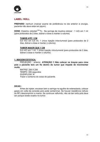 59




LABEL: ROLL
PREPARO: nenhum (marcar exame de preferência no dia anterior à cirurgia,
paciente não deve estar em jejum).
                         99m
DOSE: Estanho coloidal- Tc. Na seringa de insulina colocar : 1 mCi em 1 ml
(para protocolos de 2 dias, dobrar a dose e manter o volume).

      TUMOR ATÉ 1 CM
      0,6 mCi em 0,6 ml; 1 única injeção intra-tumoral (para protocolos de 2
      dias, dobrar a dose e manter o volume).

      TUMOR MAIOR QUE 1 CM
      0,6 mCi em 1 ml; 1 única injeção intra-tumoral (para protocolos de 2 dias,
      dobrar a dose e manter o volume).


1. IMAGEM ESTÁTICA:
      PROJEÇÃO : anterior. ATENÇÃO !! Não colocar os braços para cima
pois a paciente terá um fio dentro do tumor que impede de movimentar
muito.
      MATRIZ: 256 X 256
      TEMPO: 300 segundos
      OVERFLOW: N
       Fazer o contorno do corpo do paciente.



DICAS :
      Antes de injetar, encaixar bem a seringa na agulha de estereotaxia, colocar
gases em volta da conexão pois pode contaminar. Se houver resistência (refuxo
do RF) descomprimir a mama. Se continuar refluindo, não vai dar certo pois deve
ser porque existe cicatriz no tumor.




                                                                               59
 