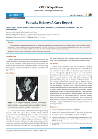 1/1
Introduction
Urinary tract defects, also called malformative uropathies, are
rankedthirdbehindcardiovascularandorthopaedicmalformations.
They include extremely varied abnormalities; some of them are
specific to the kidney, ureter, bladder or urethra. There are many
developmental renal anomalies. Pancake kidney is one of the rarest
types of them.
Case Report
Figure 1: A contrast-enhanced computed tomography
abdomen scan in the coronal section showing the pancake
kidney placed in the pelvis with right ureteropelvic junction
obstruction, associated to multiple renal calculi.
A 53-year-old male patient, with no medical or surgical history,
presented with renal colics of two months duration. Clinical
examination was normal. Biology showed a normal renal function.
An ultrasound of the urinary tract revealed two discoid pelvic
kidneys with dilation of right renal pelvis and calyces. A CT scan
concluded to pancake kidneys with right ureteropelvic junction
obstruction, associated to multiple renal calculi (Figure 1). Thus, the
patient was approached through iliac incision. Exploration found
two abnormal rotation pelvic pancake kidneys, connected by their
outer edges. He underwent a Kuss-Anderson-Hynespyeloplasty.
Dicussion
Kidney fusion anomalies were first described in 1938 by
Wilmer [1]. There are two types of abnormalities. Pancake kidneys
are connected by their poles and they form a parenchymatous
mass in pelvic position [2]. There may be two normal ureters.
Renal pelvis may communicate with one or two ureters. Pancake
kidney is an extremely rare entity with unknown incidence [3].
Looney and Duke were first to describe the pancake kidney [4].
More men are affected than women. It can be diagnosed at any
age and is frequently associated with other urinary tract defects
[5]. Pancake kidney exposes to urinary infections and renal calculi,
probably caused by rotation abnormalities and the short length
of ureters, which favor obstruction and stasis. Clinically, patients
with pancake kidney are generally asymptomatic. They sometimes
have recurrent urinary infections, abdominal pain, and even extra
urinary signs such as amenorrhea and iliac aneurysm. Patients
with pancake kidney don’t necessarily have renal insufficiency.
Asymptomatic patients will have regular checks of renal function.
Generally, we try our best to avoid unnecessary explorations and
invasive procedures.
References
1.	 Glenn JF (1958) Fused pelvic kidney. J Urol 80: 7-9.
2.	 Wein AJ (2007) Campbell-Walsh Urology (9th
edn). China, pp. 3283-3289.
3.	 Shoemaker R, Braasch WF (1939) Fused kidneys. J Urol 41: 1-7.
4.	 Looney WW, Dodd DL (1926) An ectopic (pelvic) completely fused (cake)
kidney associated with various anomalies of the abdominal viscera. Ann
Surg 84: 522-524.
5.	 Eisendrath DN, Phifer FM, Culver HB (1925) Horseshoekidney. Ann Surg
82: 735-736.
Chaker Kays*, Sellami Ahmed, Ouanes Yassine, Essid Mohamed Ali, AbidKarem, Ben Rhouma Sami and
NouiraYassine
Department of Urology, La Rabta Hospital, Tunis, Tunisia
*Corresponding author: ChakerKays, Department of Urology, La Rabta Hospital, Tunis, Tunisia
Submission: November 13, 2017; Published: January 11, 2018
Pancake Kidney: A Case Report
Surg Med Open Acc J
Copyright © All rights are reserved by ChakerKays. 1(2).SMOAJ.000508. 2018.
CRIMSONpublishers
http://www.crimsonpublishers.com
Abstract
There are many developmental anomalies of the kidney. Pancake kidney is one of the rarest types of renalectopia. We report a case of pancake
kidney which was detected incidentally while treating a male patient for renal colics. A CT scan concluded to pancake kidneys with right ureteropelvic
junction obstruction, associated to multiple renal calculi. He underwent a Kuss-Anderson-Hynes pyeloplasty.
Keywords: Pancake kidney; Ureteropelvic junction obstruction; Pyeloplasty
Volume 1 - Issue - 2
Case Report
ISSN 2578-0379
 
