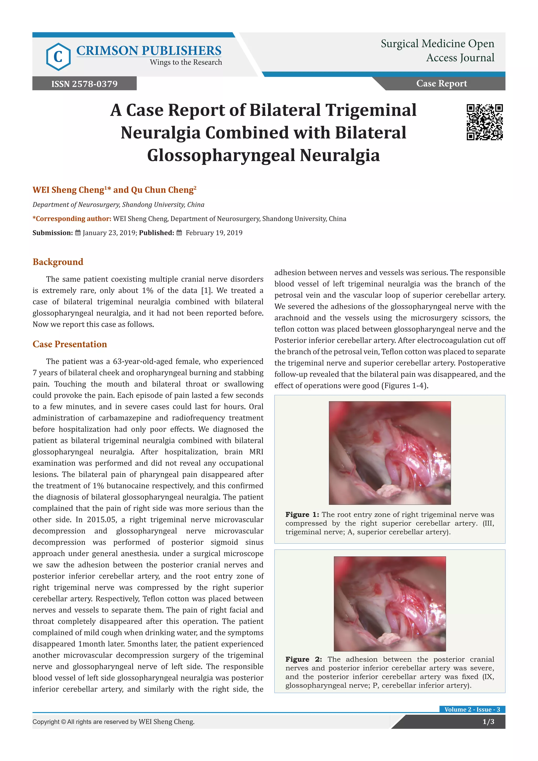 A Case Report of Bilateral Trigeminal Neuralgia Combined with Bilateral ...