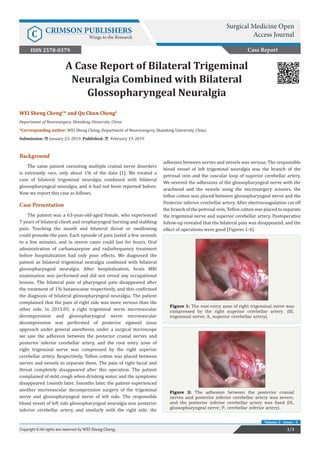 A Case Report of Bilateral Trigeminal Neuralgia Combined with Bilateral ...
