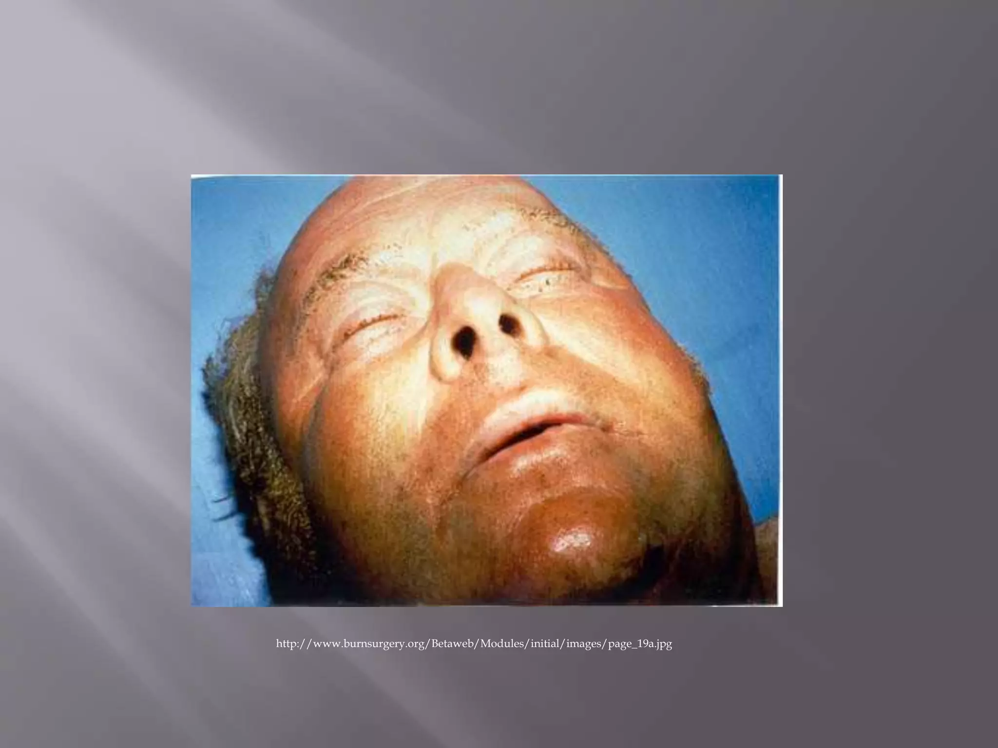 Smoke inhalation PPT