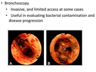 • Bronchoscopy
• Invasive, and limited access at some cases
• Useful in evaluating bacterial contamination and
disease progression
 