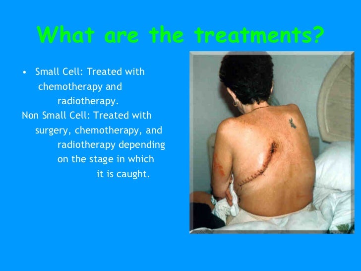 Smoking & Cancer PPT