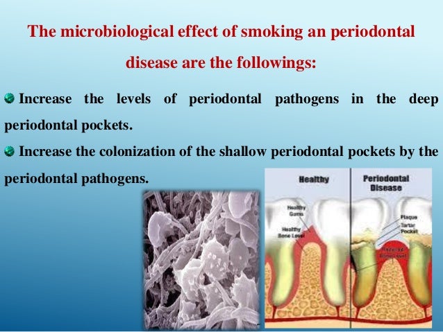 Smoking and periodontal disease