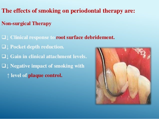 Smoking and periodontal disease