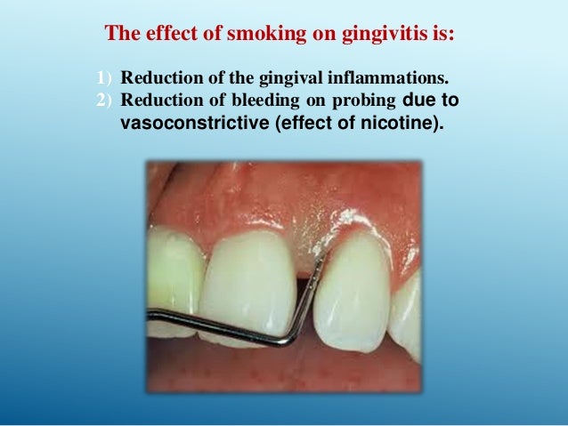 Smoking and periodontal disease