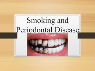 Smoking and
Periodontal Disease
 