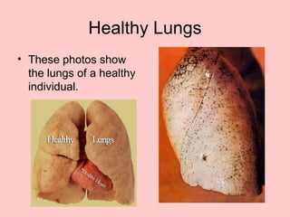 Healthy Lungs
• These photos show
the lungs of a healthy
individual.
 