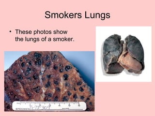 Smokers Lungs
• These photos show
the lungs of a smoker.
 