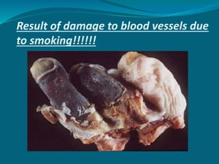 Result of damage to blood vessels due
to smoking!!!!!!
 