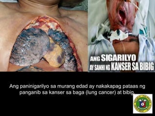 Ang paninigarilyo sa murang edad ay nakakapag pataas ng
panganib sa kanser sa baga (lung cancer) at bibig.
 