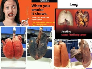 Lung
10
 